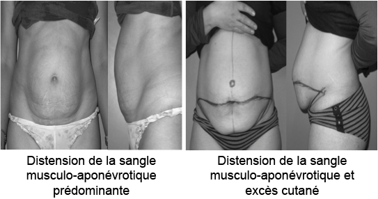 Abdominoplastie  Docteur Julien PAUCHOT