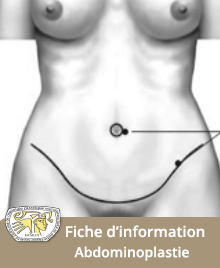 Abdominoplastie  Docteur Julien PAUCHOT