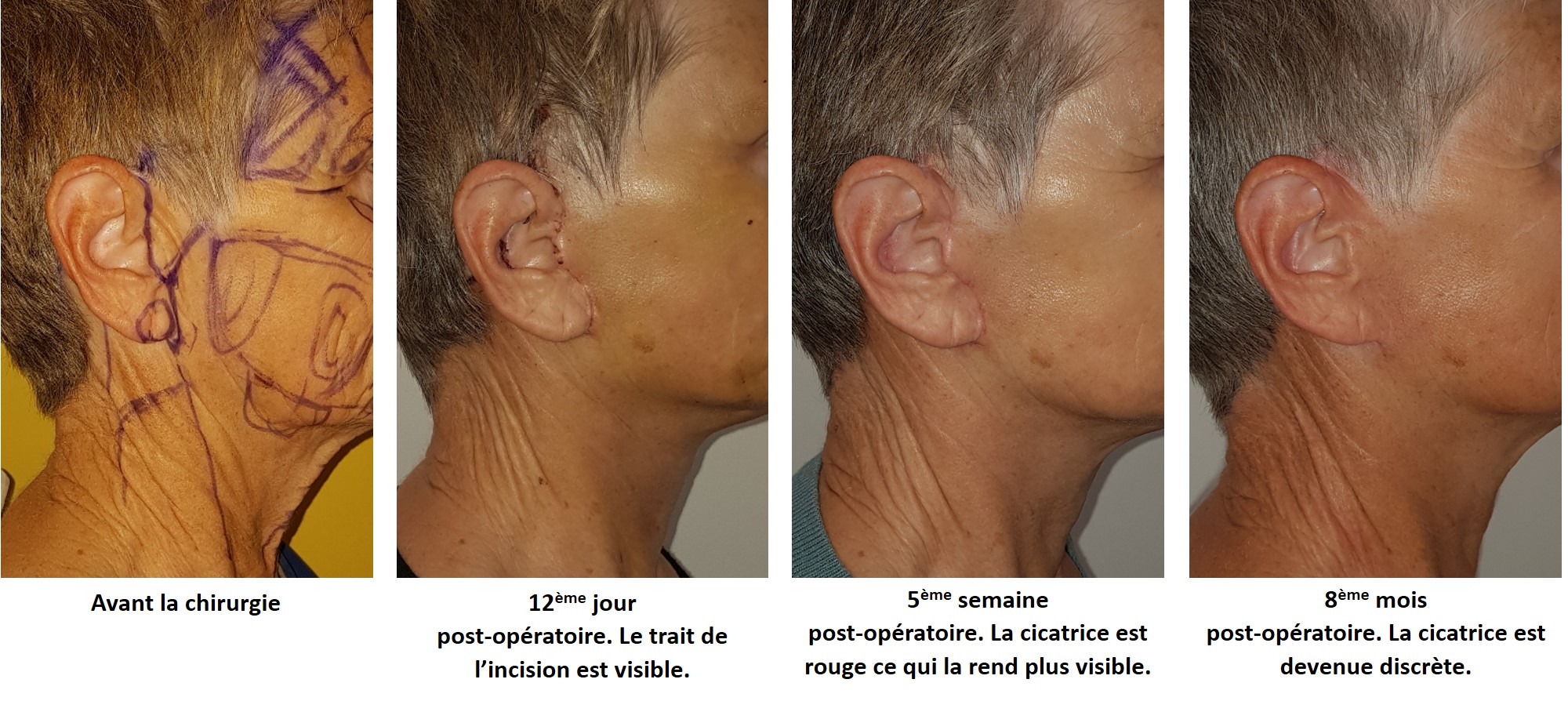 Pansement Silicone Cicatrice Pour les Cicatrices Causées par la Cés